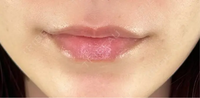 ヒアルロン酸注入（唇） / ボトックス（口角） ルラ美容クリニック 大阪本院 BEFORE メイン用