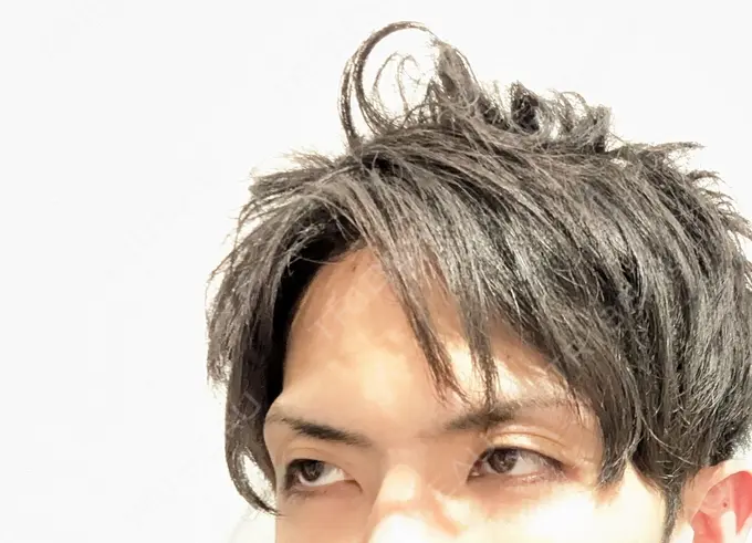 クマ治療 ネビュラクリニック 東京錦糸町院 BEFORE メイン用