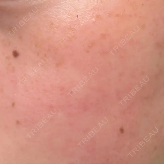 イオン導入 / ルメッカ ルラ美容クリニック 仙台院 / ルラスキンクリニック 仙台院 BEFORE メイン用