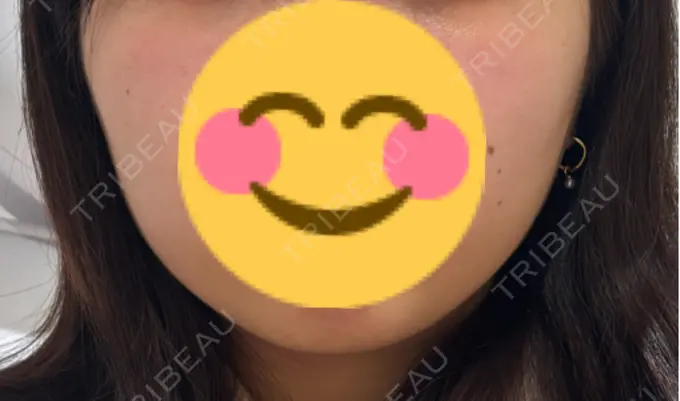 糸リフト / 脂肪吸引（顔） / 脂肪吸引注射（顔） ziz CLINIC BEFORE メイン用