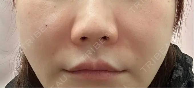 ヒアルロン酸注入（鼻翼基部） ルラ美容クリニック 仙台院 / ルラスキンクリニック 仙台院 BEFORE メイン用