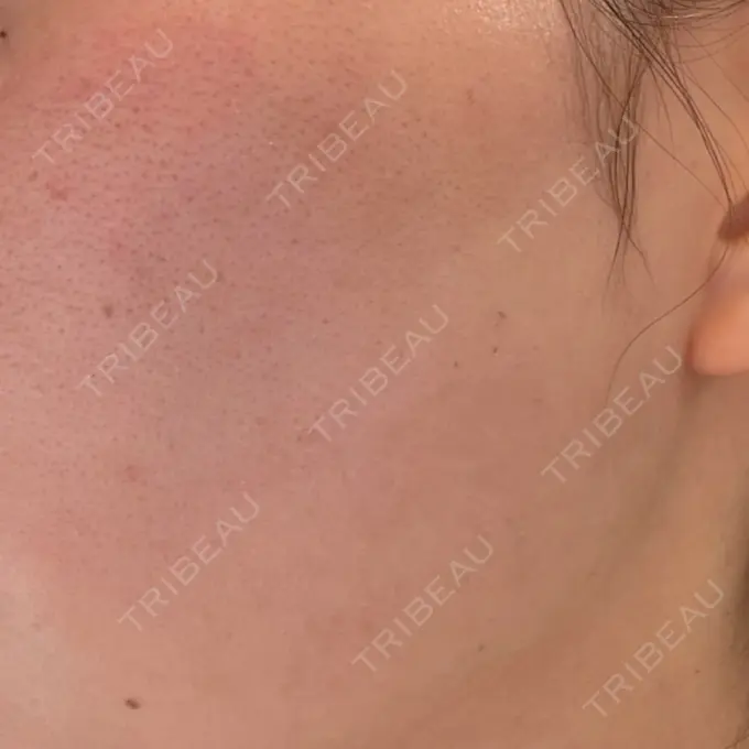 肌育注射（ジュベルックなど） メディアージュクリニック 青山院 BEFORE メイン用