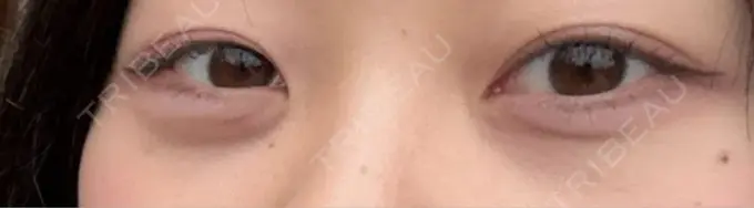 クマ治療 / 脂肪注入（目の下） 湘南美容クリニック 千葉センシティ院 BEFORE メイン用