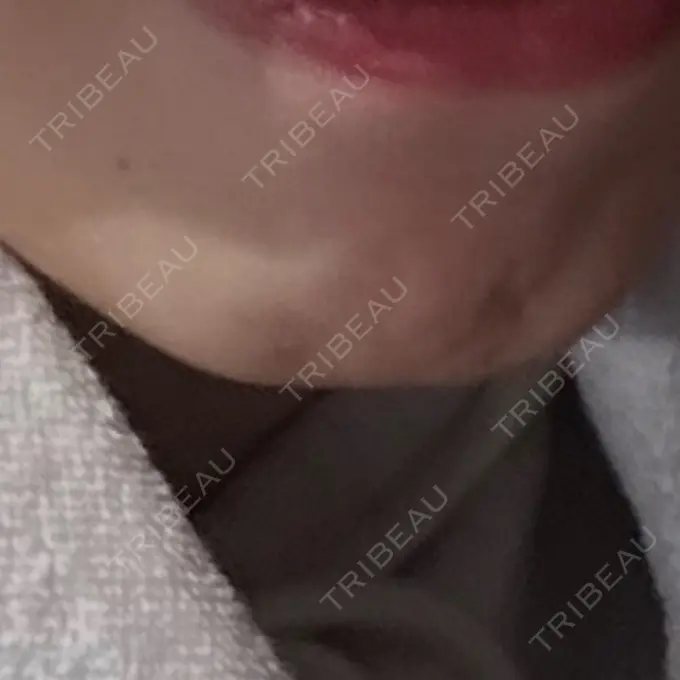 ボトックス（あご） / ボトックス（エラ・小顔） 湘南美容クリニック 横浜院 BEFORE メイン用