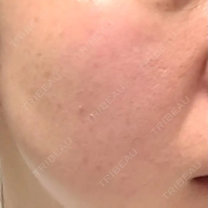 光治療（フォトフェイシャルなど） 仙台TAクリニック BEFORE メイン用