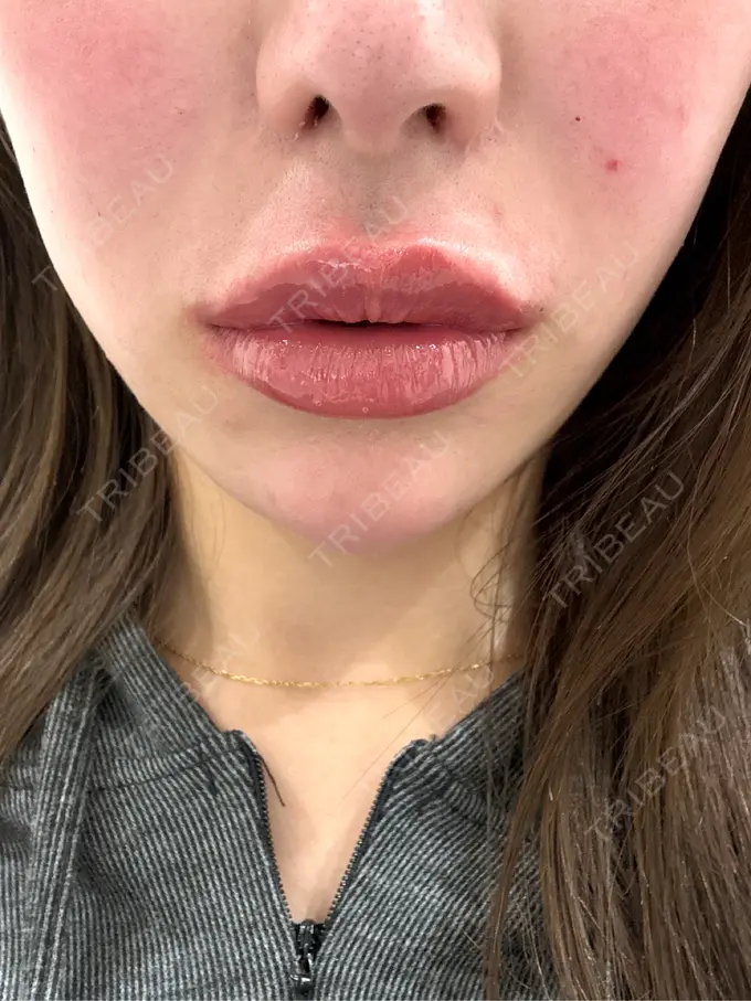 肌ヒアルロン酸注入（たるみ・シワ改善） HAAB×DREAM BEAUTY CLINIC 大阪梅田院 BEFORE メイン用