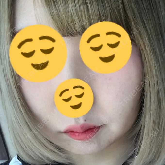 糸リフト 湘南美容クリニック 長野院 BEFORE メイン用