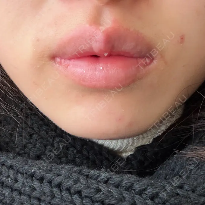 ボトックス（あご） / ボトックス（エラ・小顔） / ボトックス（口角） ルラ美容クリニック 神戸院 BEFORE メイン用