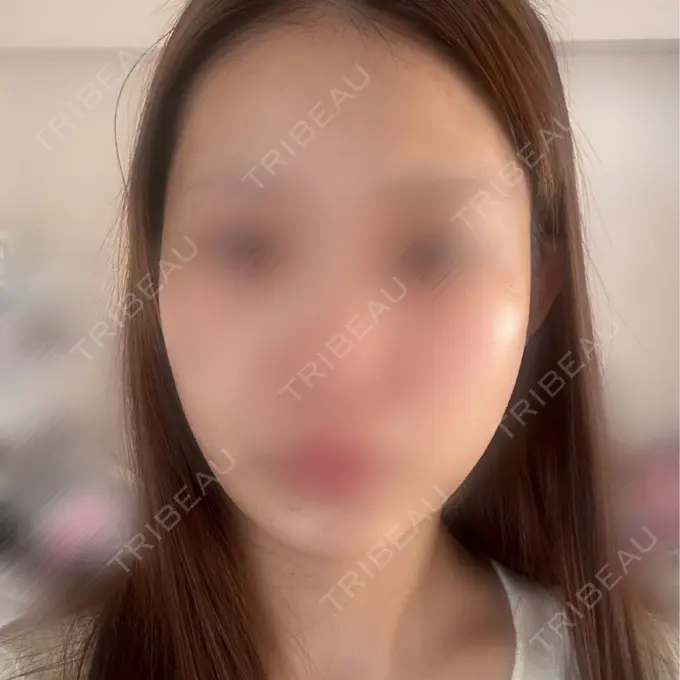 ボルニューマ ルラ美容クリニック 札幌大通り院 BEFORE メイン用