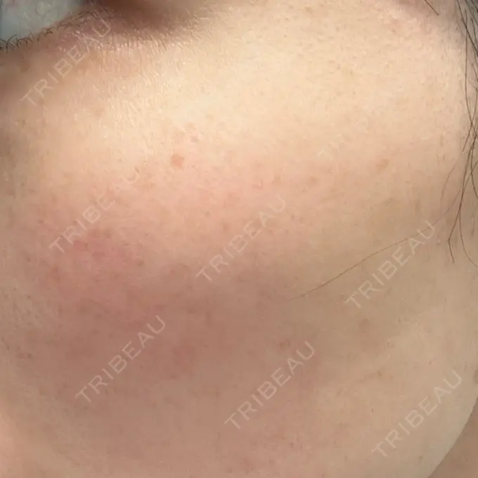 ピコレーザートーニング（美白・肝斑） おおかみ美容のクリニック 横浜院 BEFORE メイン用