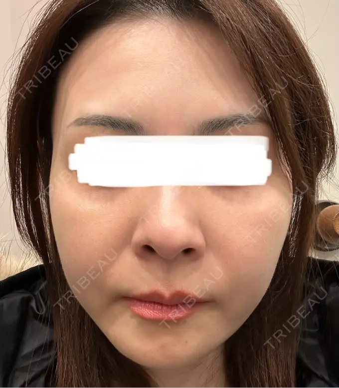 ボトックス（あご） / ボトックス（エラ・小顔） TCB東京中央美容外科 三島院 BEFORE メイン用