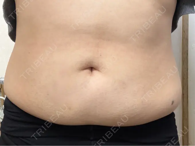 脂肪溶解注射（お腹） FIG CLINIC BEFORE メイン用