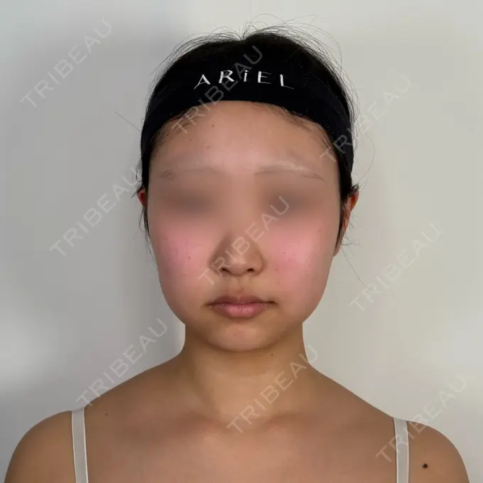 糸リフト / 脂肪吸引（顔） / ジョールファット除去 アリエル美容クリニック 水戸院 BEFORE メイン用