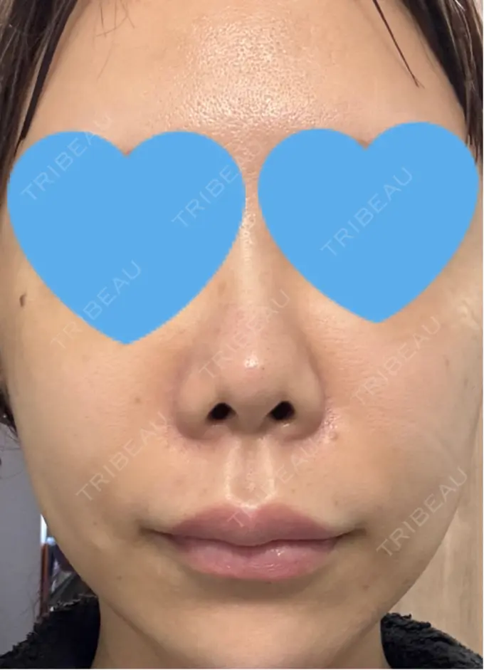 ボトックス（あご） / ボトックス（口角） / ボトックス（眉間） / ボトックス（目尻） / ボトックス（額） / ボトックス（人中） / その他（目元） eクリニック 岡山院 BEFORE メイン用