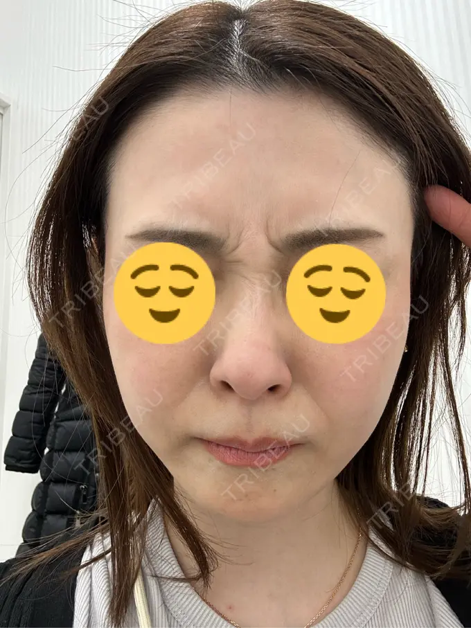 ボトックス（眉間） / ボトックス（額） TCB東京中央美容外科 三島院 BEFORE メイン用