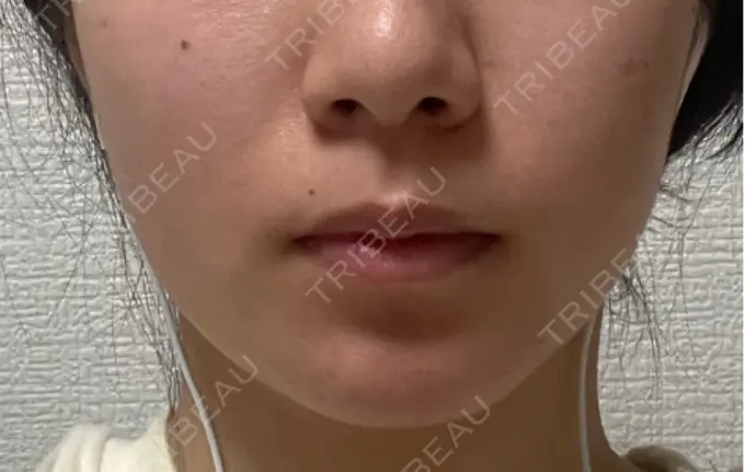 糸リフト / 脂肪吸引（顔） Otus Clinic 【オータスクリニック】 BEFORE メイン用