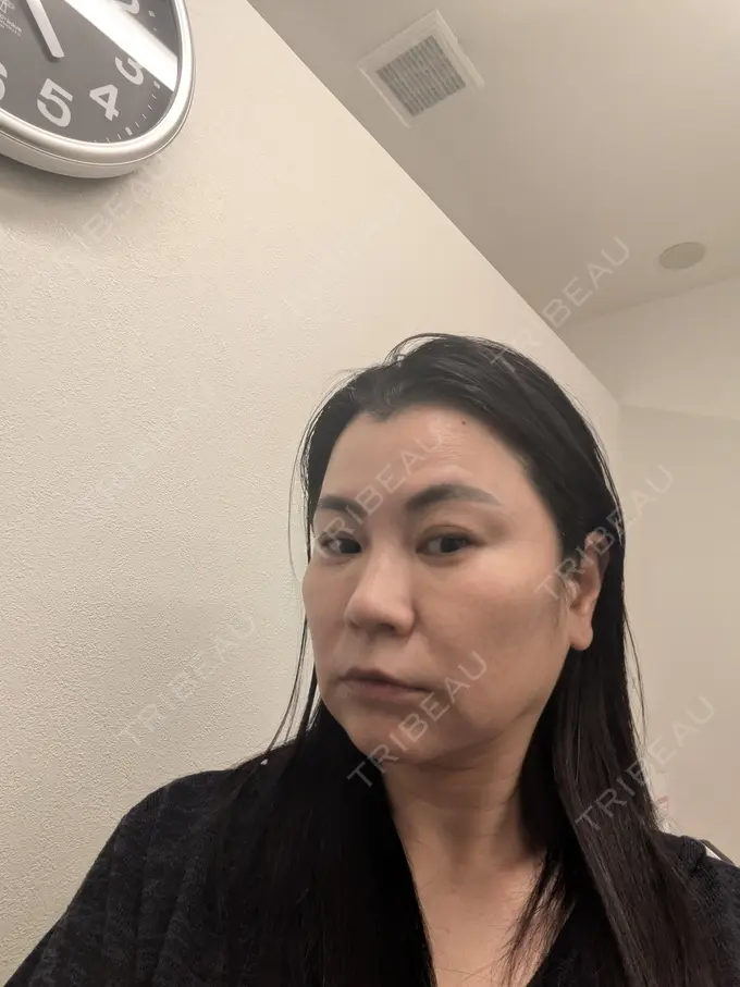 ボトックス（眉間） / ボトックス（額） / 美容点滴・美容注射（疲労回復） / ボトックス（バニーライン） TCB東京中央美容外科 松山院 BEFORE メイン用