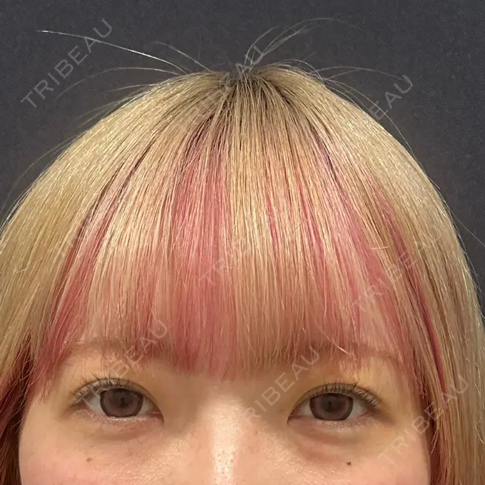 ヒアルロン酸注入（涙袋） YBC横浜美容外科 立川院 BEFORE メイン用