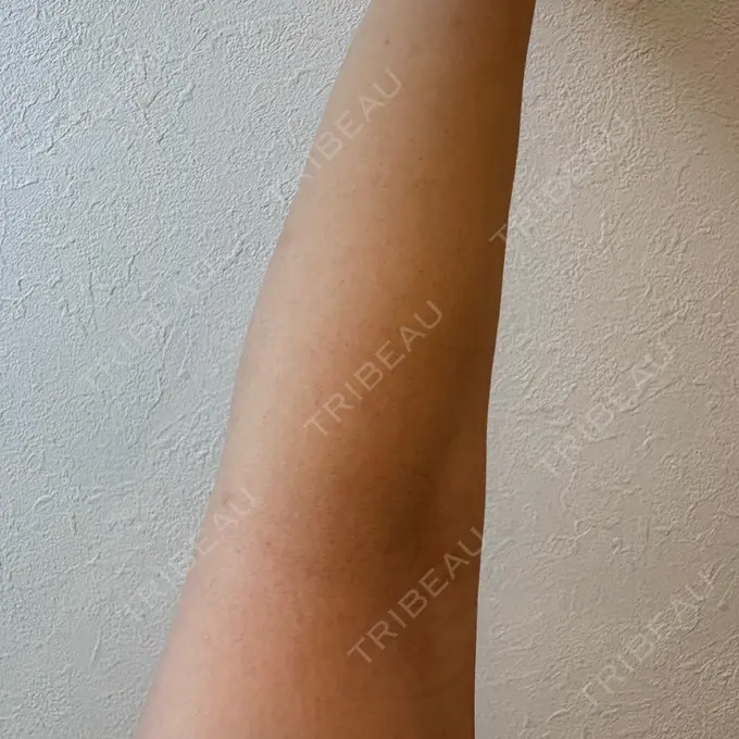 医療脱毛（全身） おおかみ美容のクリニック 横浜院 BEFORE メイン用