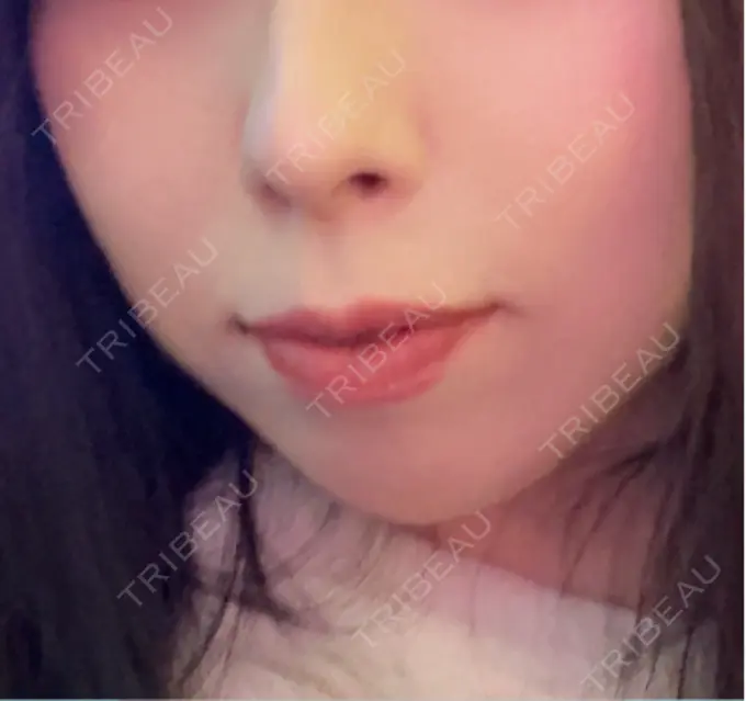 チタニウムリフト 博多美容外科/美容皮膚科 ビラビューティークリニック BEFORE メイン用