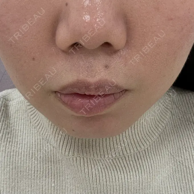 ヒアルロン酸注入（あご） / ボトックス（エラ・小顔） ルラ美容クリニック 大阪本院 BEFORE メイン用