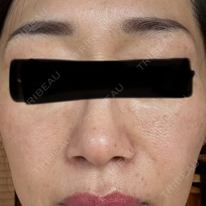 ピーリング（ハリ・ツヤ） アーククリニック BEFORE メイン用