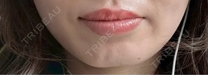 ヒアルロン酸注入（あご） 新未来クリニック BEFORE メイン用