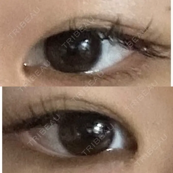 目頭切開 つだ美容外科クリニック BEFORE メイン用