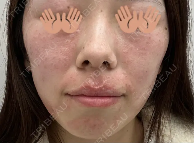 ピコレーザートーニング（美白・肝斑） / ピコスポット 東京シルククリニック 東京神田院 BEFORE メイン用