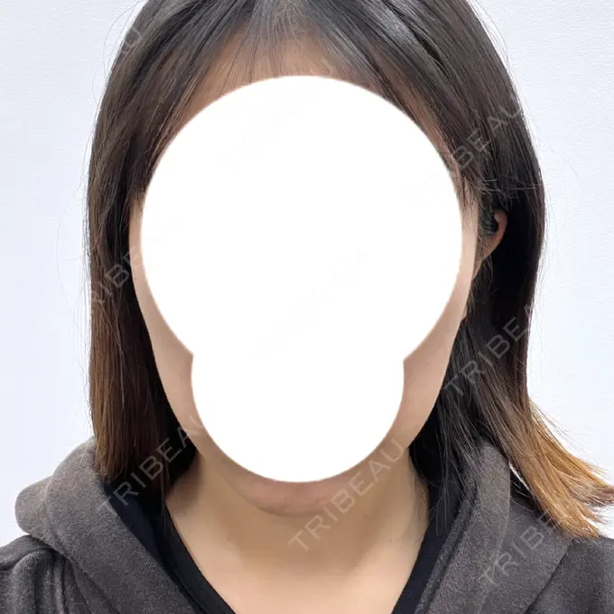 インモード 東京美容皮膚科アロエクリニック池袋 BEFORE メイン用