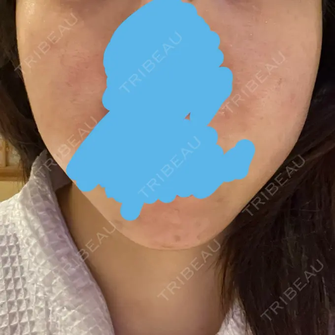 医療脱毛（顔） VERDE CLINIC お茶の水（ベルデクリニックお茶の水） BEFORE メイン用