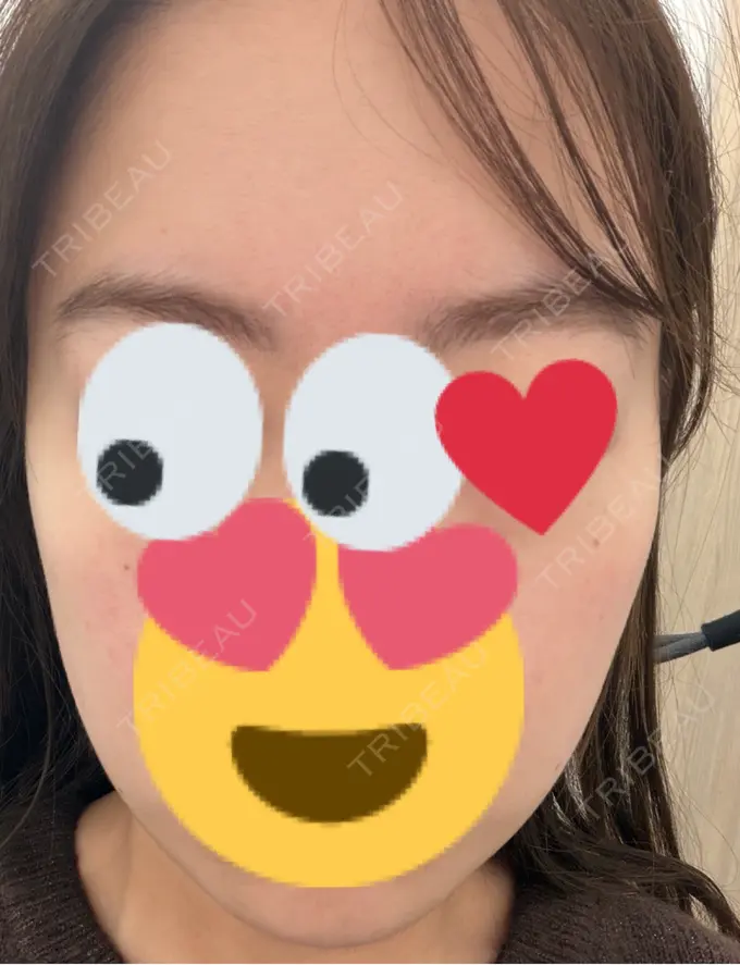 医療脱毛（顔） VERDE CLINIC お茶の水（ベルデクリニックお茶の水） BEFORE メイン用