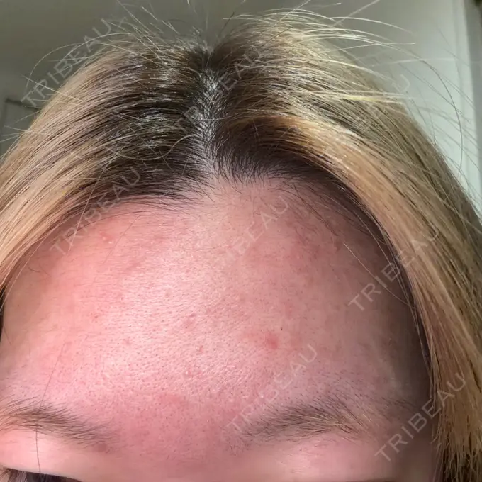 ボトックス（眉間） / ボトックス（額） / その他（鼻） TCB東京中央美容外科 姫路院 BEFORE メイン用