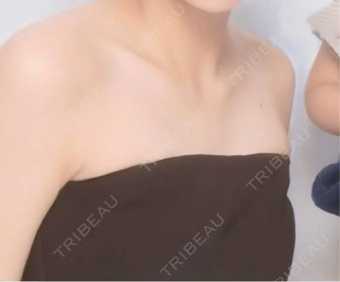 ボトックス（肩） メディカルアルファクリニック BEFORE メイン用