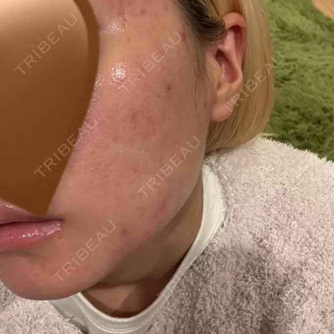 肌育注射（ジュベルックなど） / エレクトロポレーション ハナビューティークリニック BEFORE メイン用