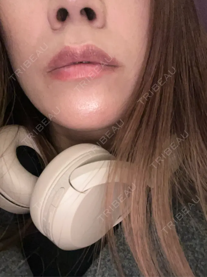 ボトックス（口角） / ボトックス（額） メディカルアルファクリニック BEFORE メイン用