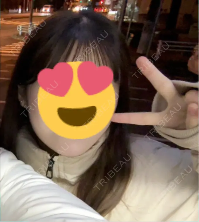 ボトックス（エラ・小顔） / ボトックス（肩） 上野注入クリニック BEFORE メイン用