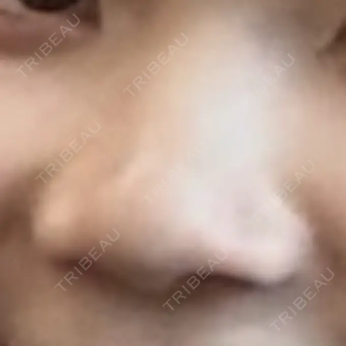 シワ取りボトックス ルラ美容クリニック 池袋院 BEFORE メイン用