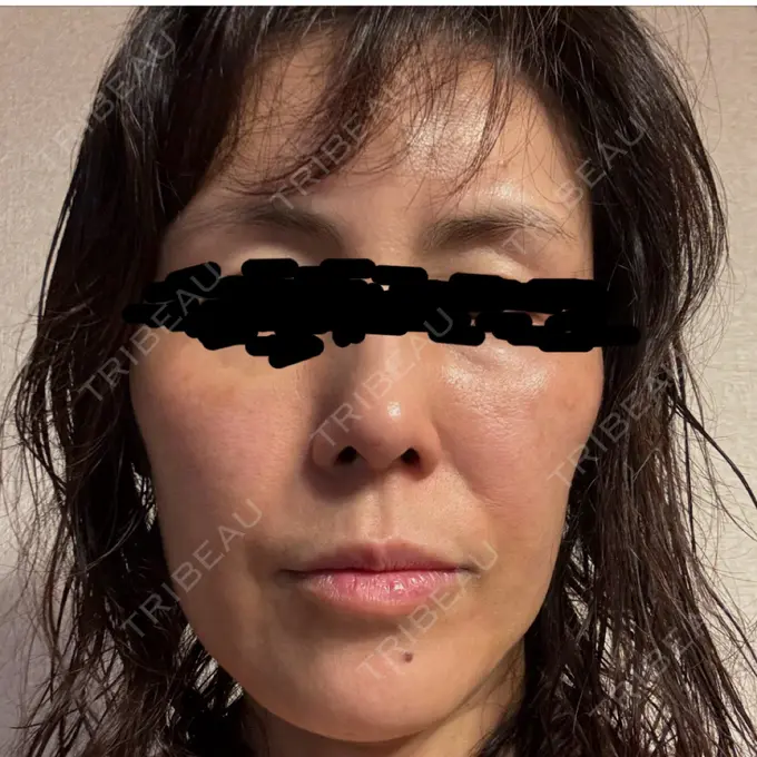 肌育注射（ジュベルックなど） / ジャルプロ ウィルビークリニック 新宿院 BEFORE メイン用