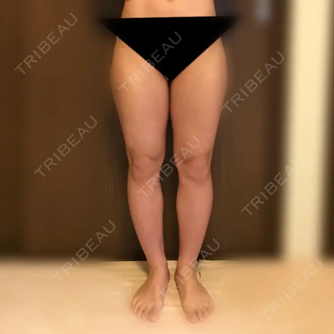 脂肪吸引（脚） / 脂肪吸引（お尻） 湘南美容クリニック 仙台院 BEFORE メイン用