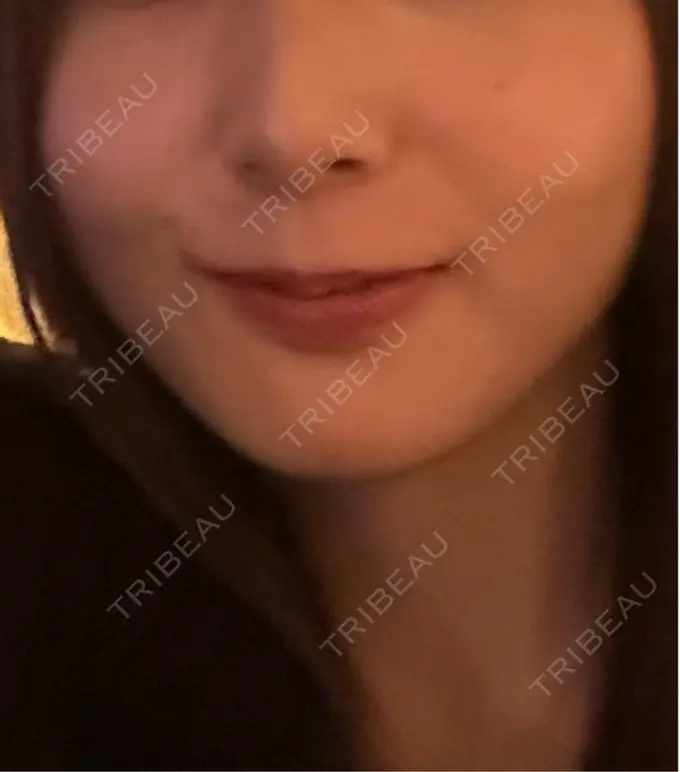 医療脱毛（顔） VERDE CLINIC お茶の水（ベルデクリニックお茶の水） BEFORE メイン用