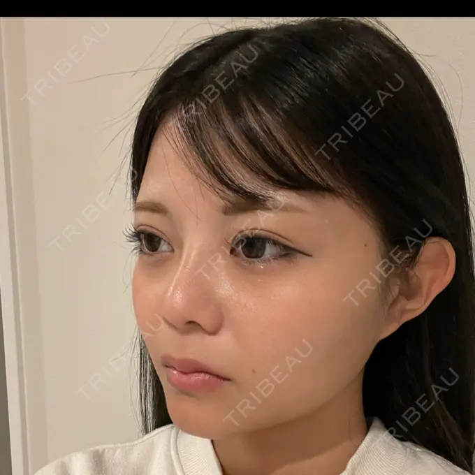 糸リフト / あご下筋肉縛り WOM CLINIC GINZA （ワム クリニック ギンザ） BEFORE メイン用