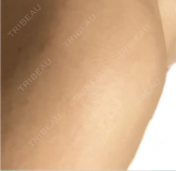 プラセンタ注射 美容皮膚科エルムクリニック 麻布院 BEFORE メイン用