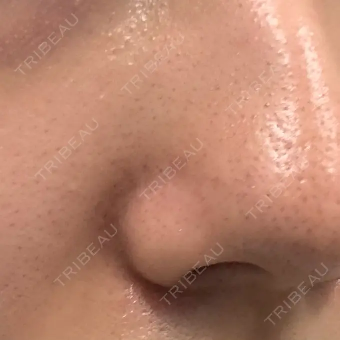 毛穴洗浄（ハイドラフェイシャルなど） / ルメッカ 東京シルククリニック 東京神田院 BEFORE メイン用