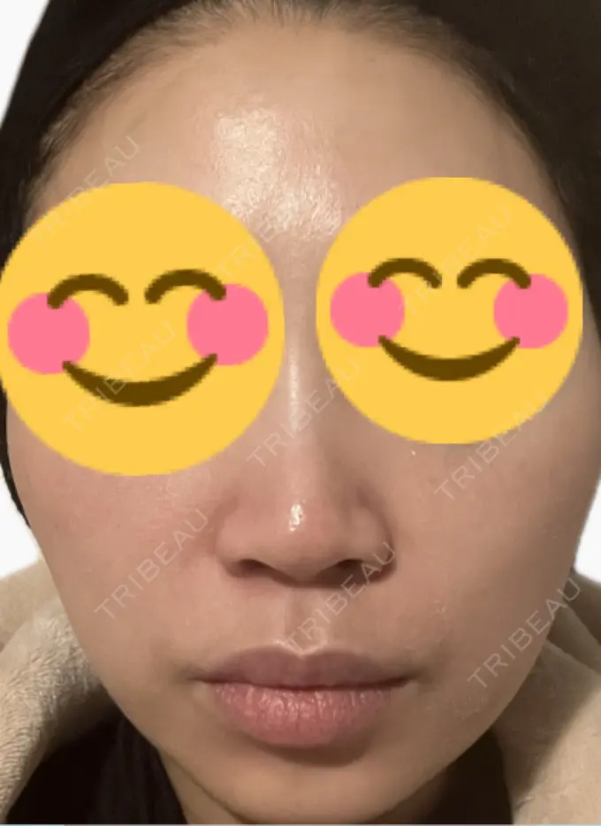 ルメッカ 東京シルククリニック 新宿院 BEFORE メイン用