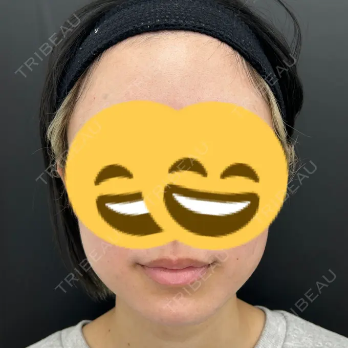 ボトックス（エラ・小顔） / ボトックス（口角） / ボトックス（眉間） / ボトックス（人中） つだ美容外科クリニック BEFORE メイン用