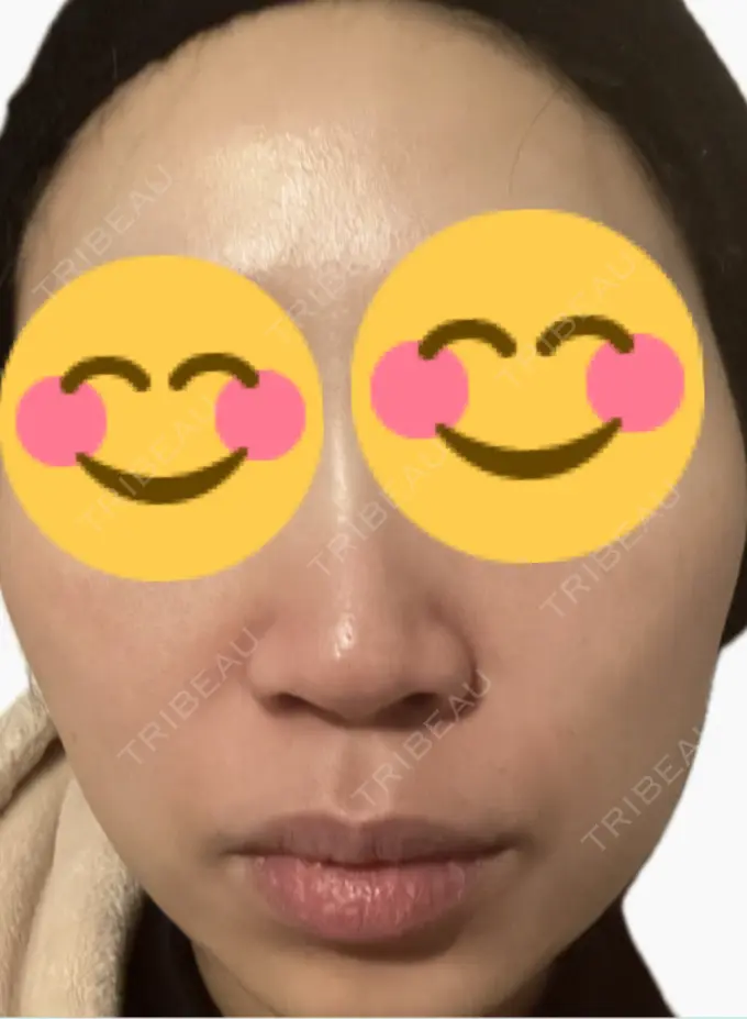 肌育注射（ジュベルックなど） 美容皮膚科エルムクリニック 麻布院 BEFORE メイン用