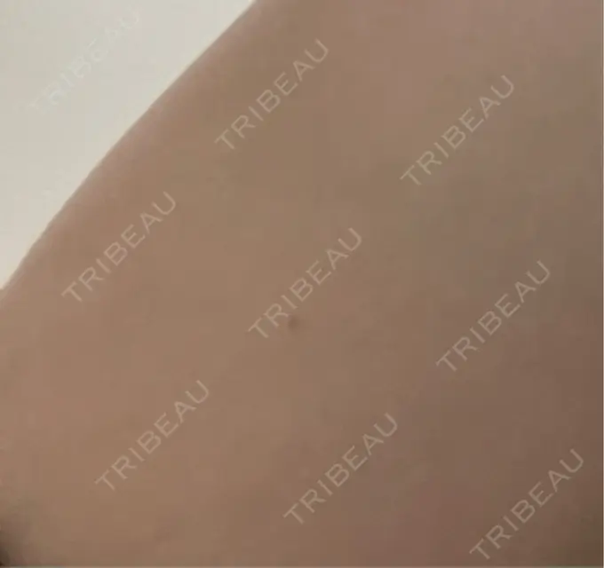 プラセンタ注射 美容皮膚科エルムクリニック 麻布院 BEFORE メイン用