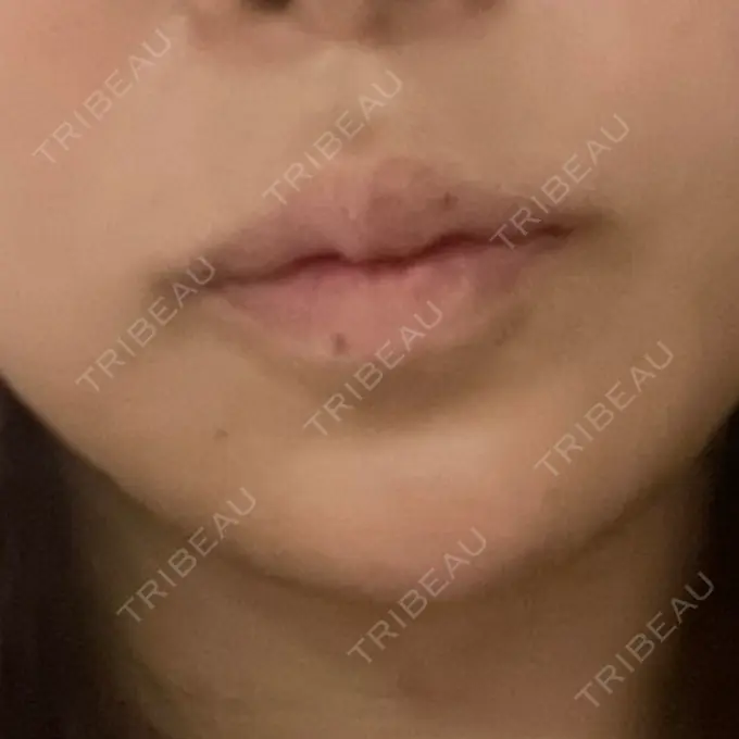 ボトックス（あご） / ボトックス（口角） / ボトックス（眉間） / ボトックス（首） / ボトックス（ガミースマイル） STELLA LUNNA CLINIC BEFORE メイン用