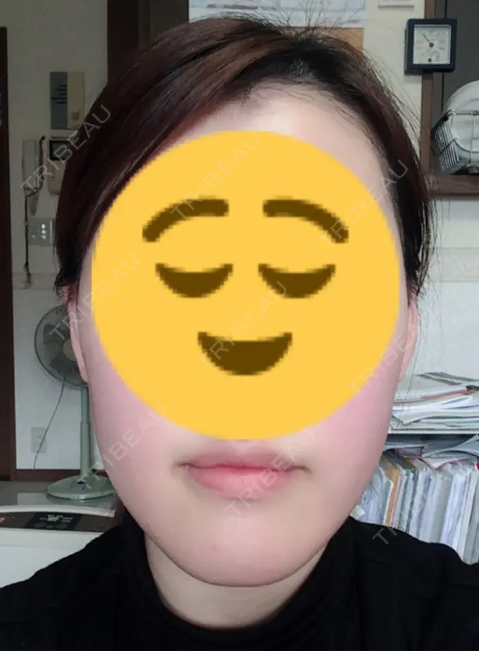 骨切り（あご） / その他（輪郭） マックスファクス銀座クリニック BEFORE メイン用